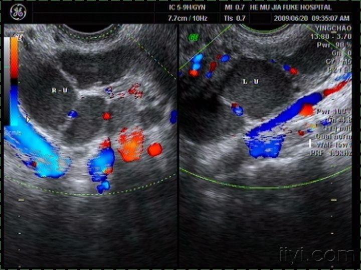 输卵管积水严重图图片