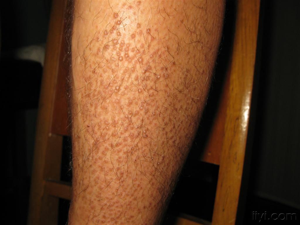 看图识病皮肤淀粉样变