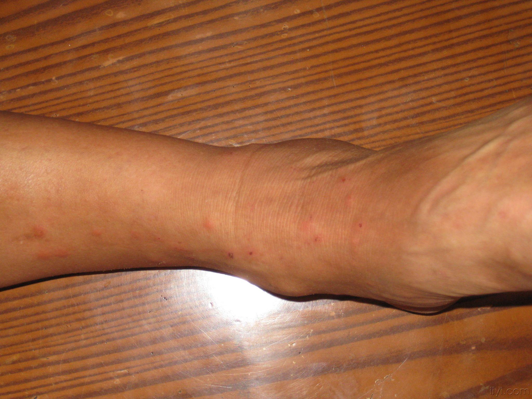 脚踝荨麻疹图片