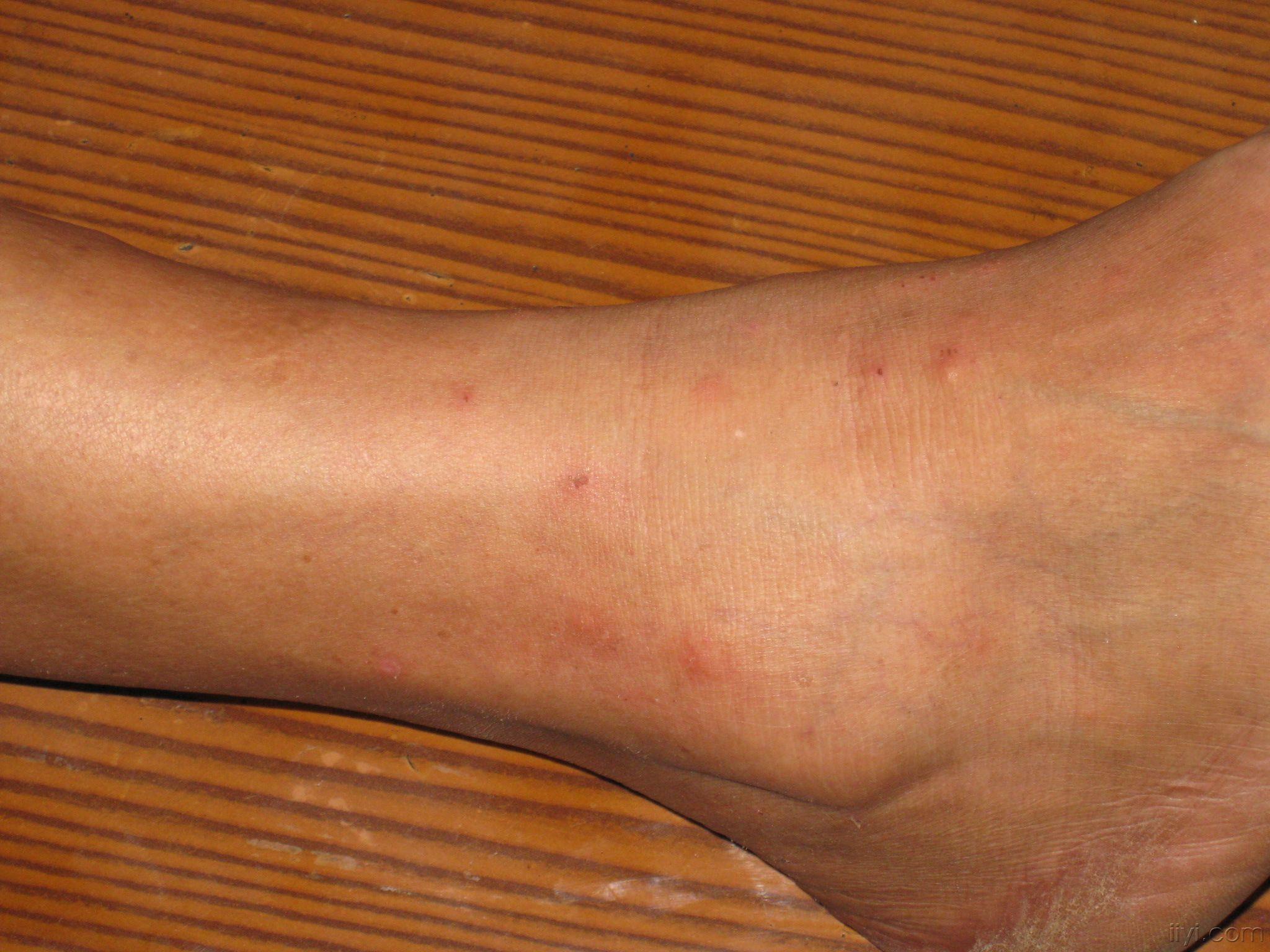 脚踝荨麻疹图片