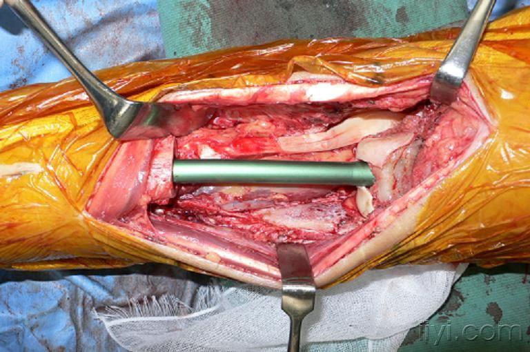 髓内钉手术过程图片图片