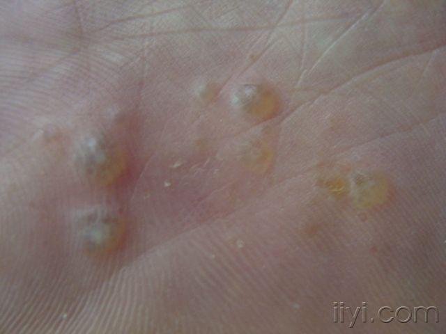 水泡足藓初期症状图片图片