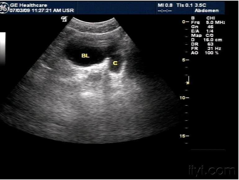 膀胱憩室. - 超声医学讨论版 - 爱爱医医学论坛