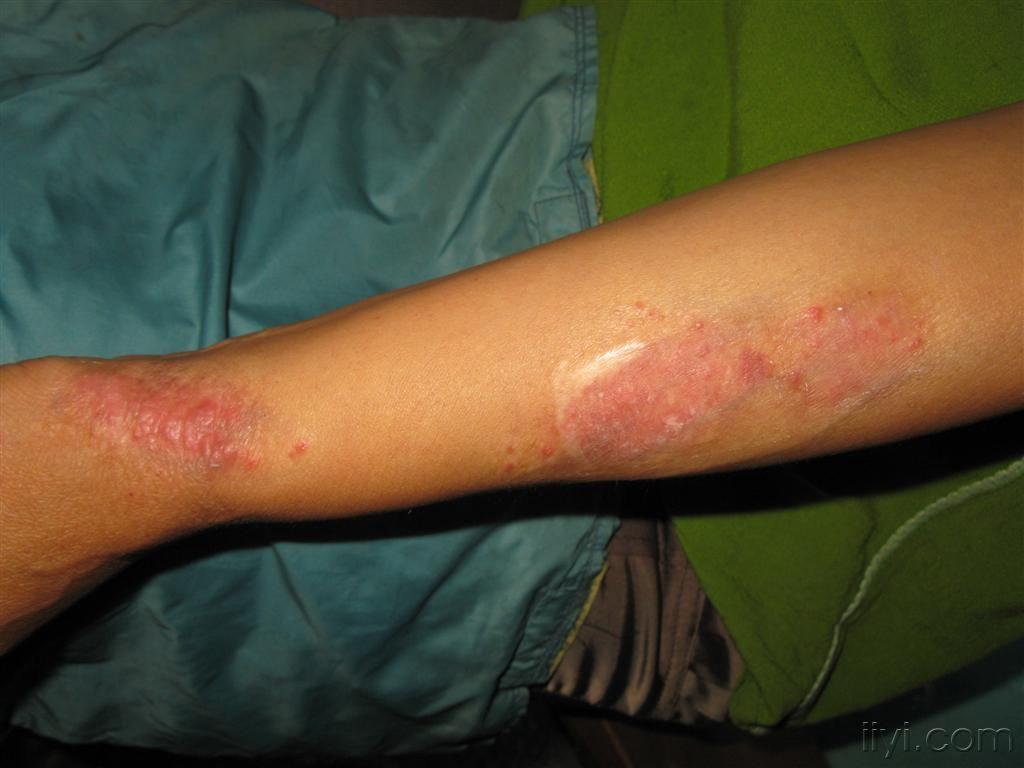 看图识病左臂线状丘疹