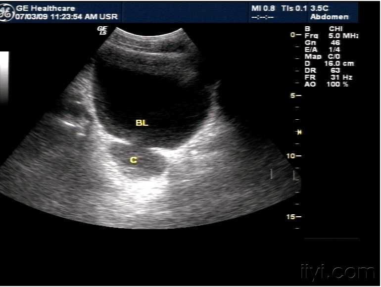 膀胱憩室. - 超声医学讨论版 - 爱爱医医学论坛