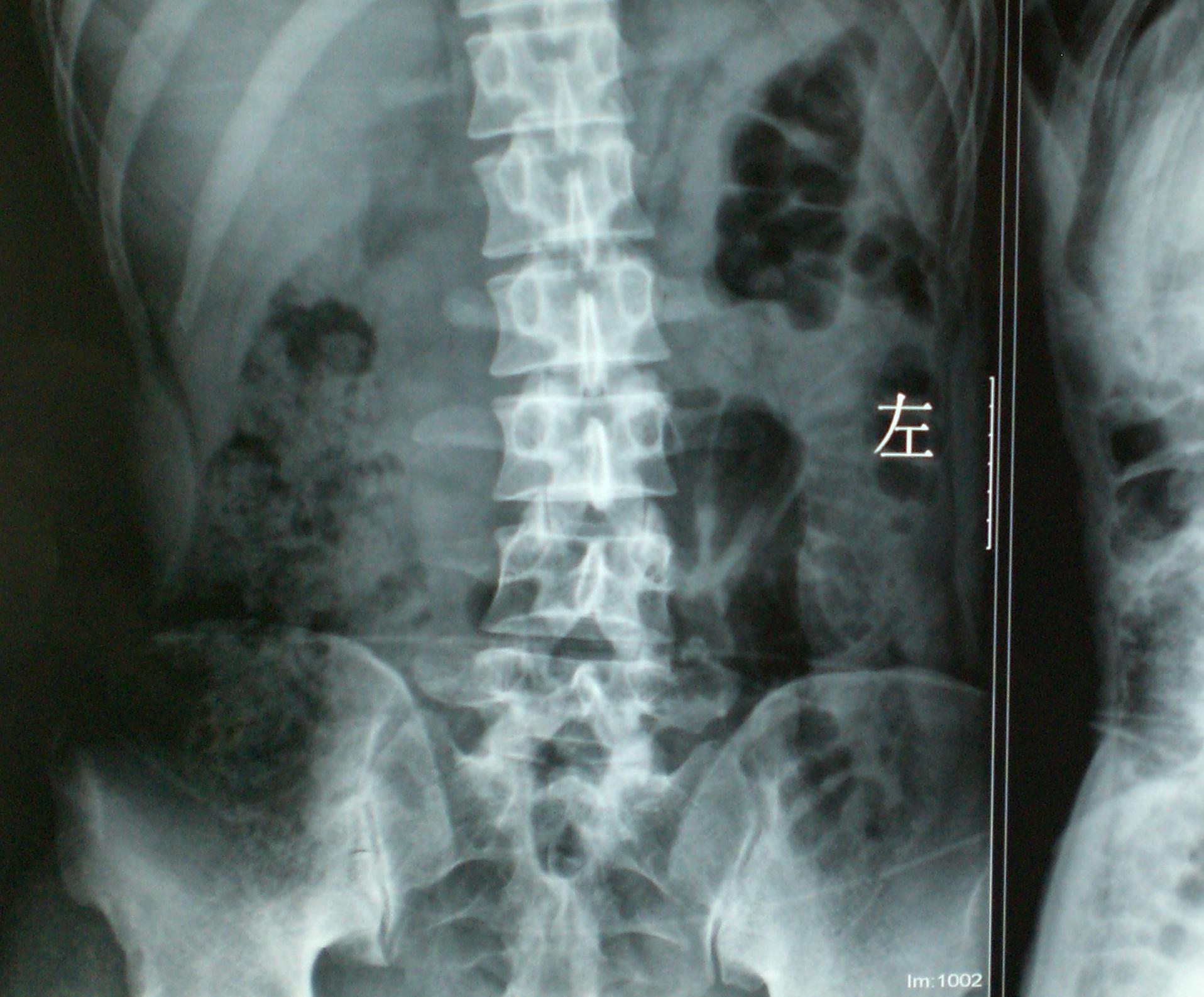 骨科医生们帮忙看看,谢谢了