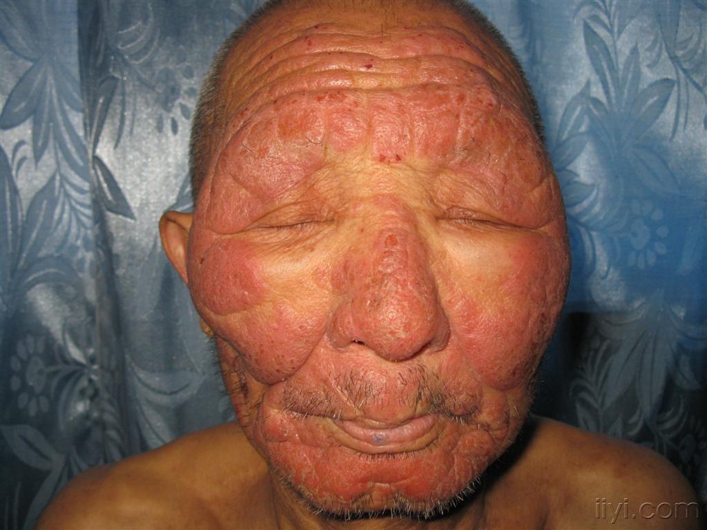 皮肤病看图识病慢性光化性皮炎