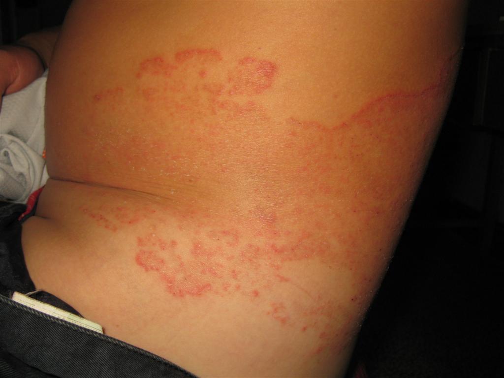 又是癣花飘香时