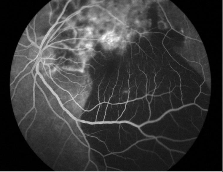 眼底出血造影图片图片