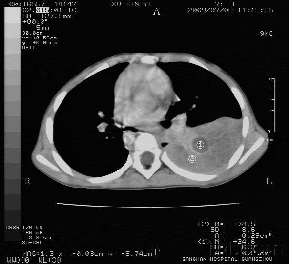 第十一天胸部ct增強的片子
