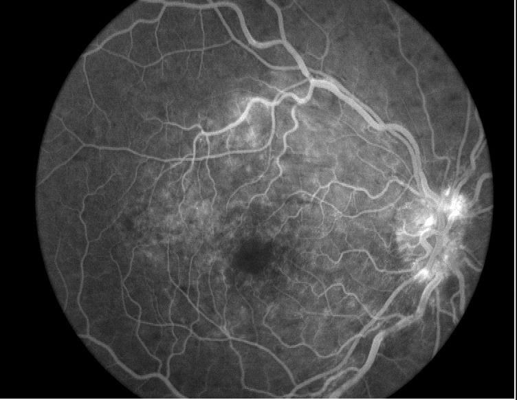 高血压眼底黄斑区有遮荧光大面积渗出3.jpg
