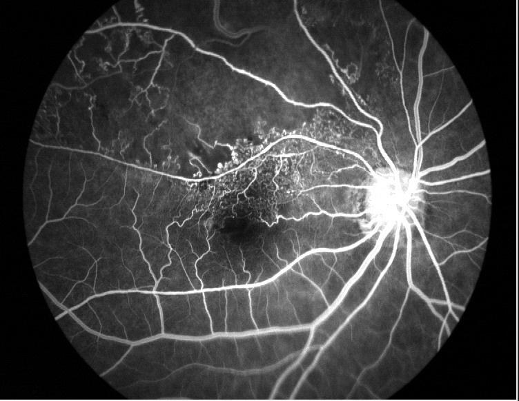 糖尿病视网膜眼底(无灌注区,新生血管)jpg