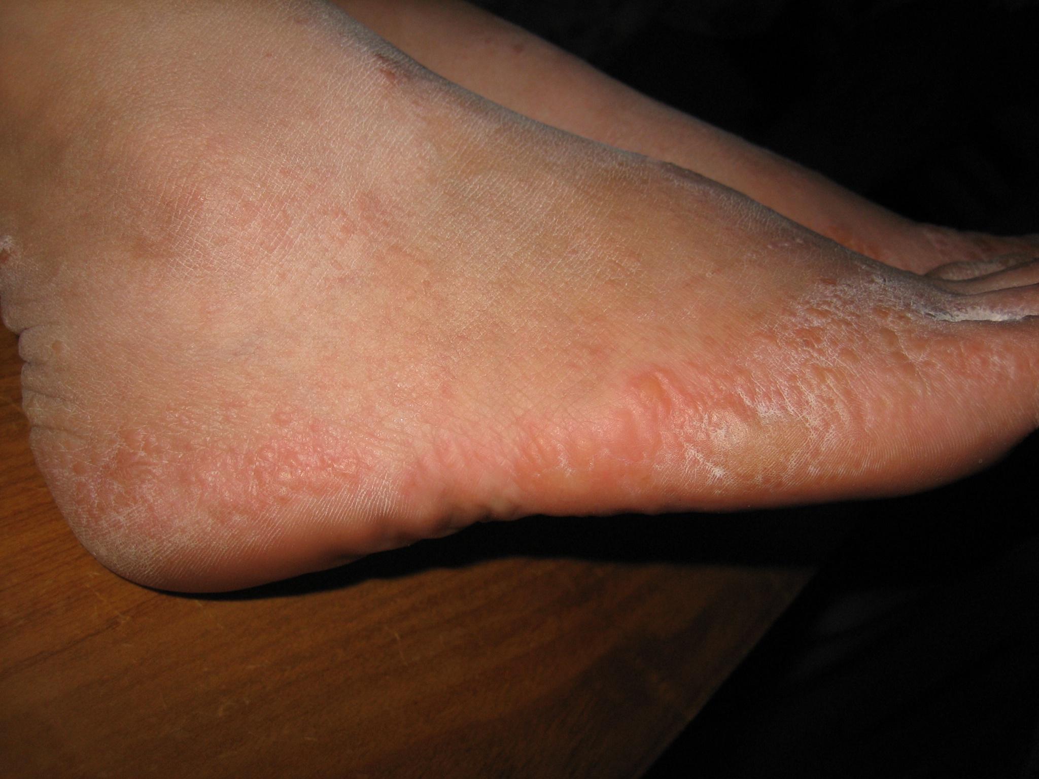 脚汗疱疹初期图片图片