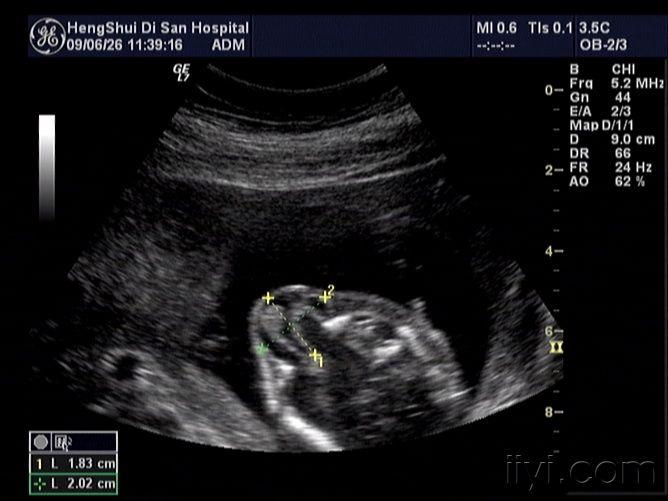7个月胎儿脑膨出图片图片