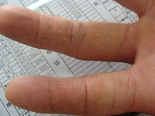 手指干裂,脱屑 - 皮肤及性传播疾病讨论版 - 爱爱医医学论坛