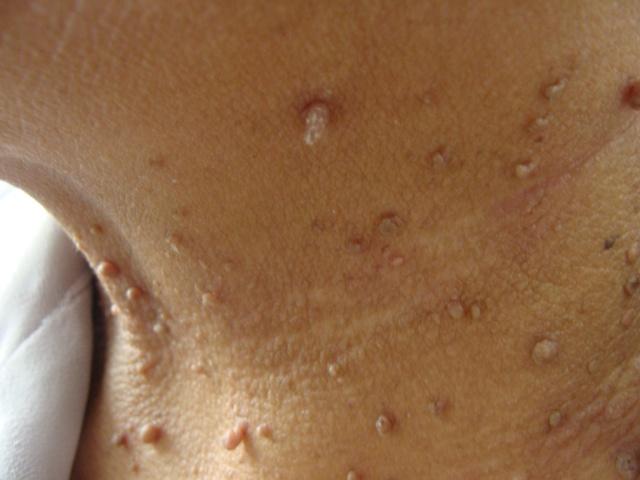 皮肤软组织纤维瘤图片图片