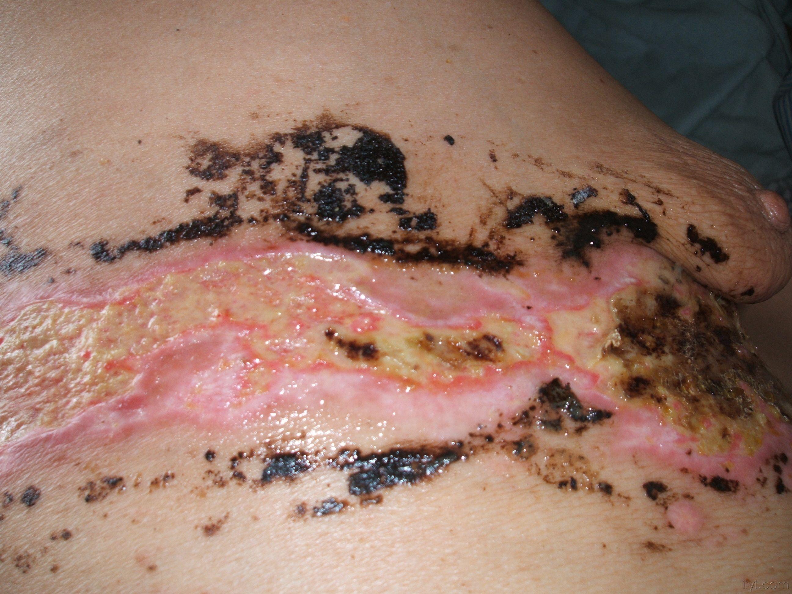 带状疱疹留下的疤痕图图片