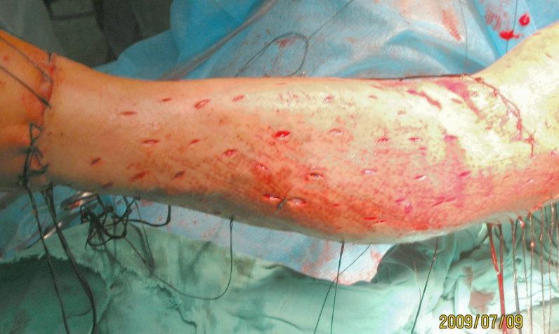 小儿下肢碾挫伤