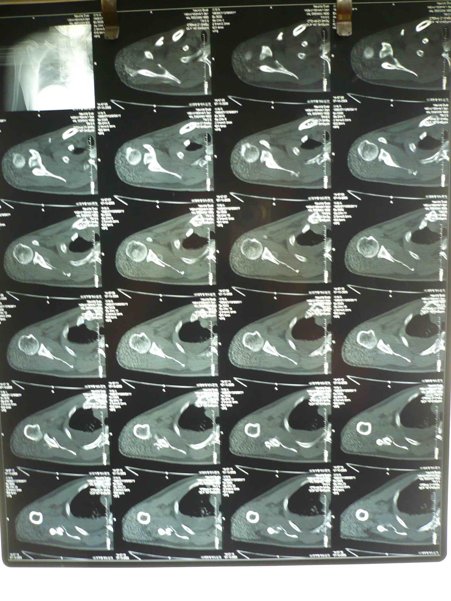 讨论:漂浮肩并臂丛神经损伤的治疗