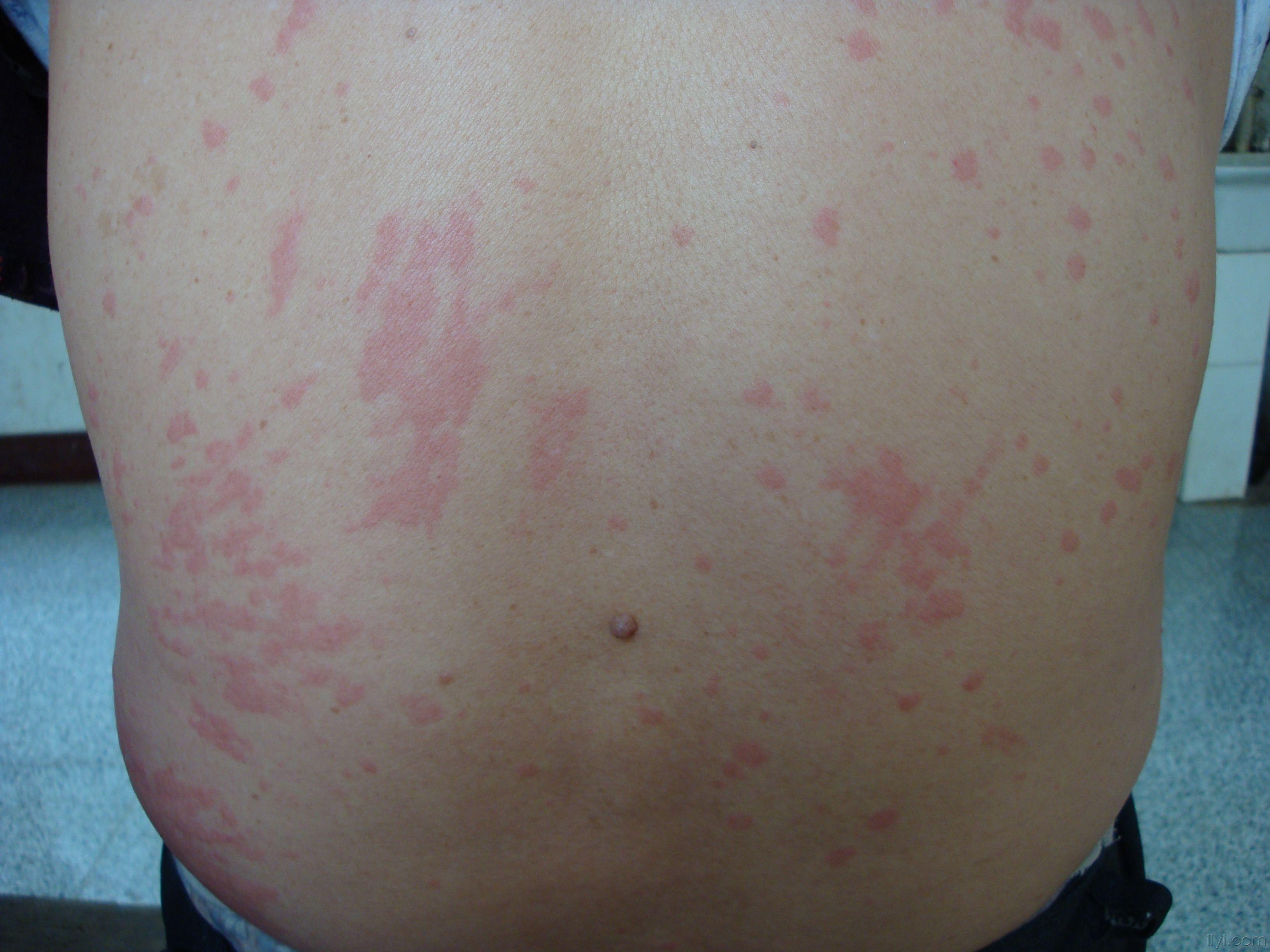 荨麻疹变成大片红斑图片
