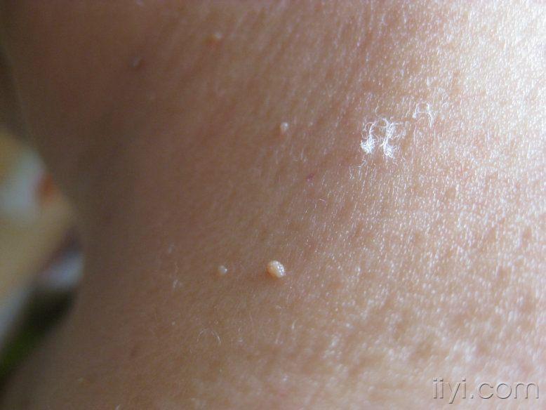皮肤黏膜赘生物图片图片