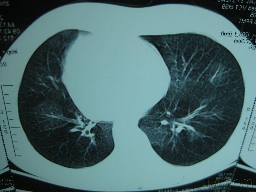 肺部毛玻璃片图片