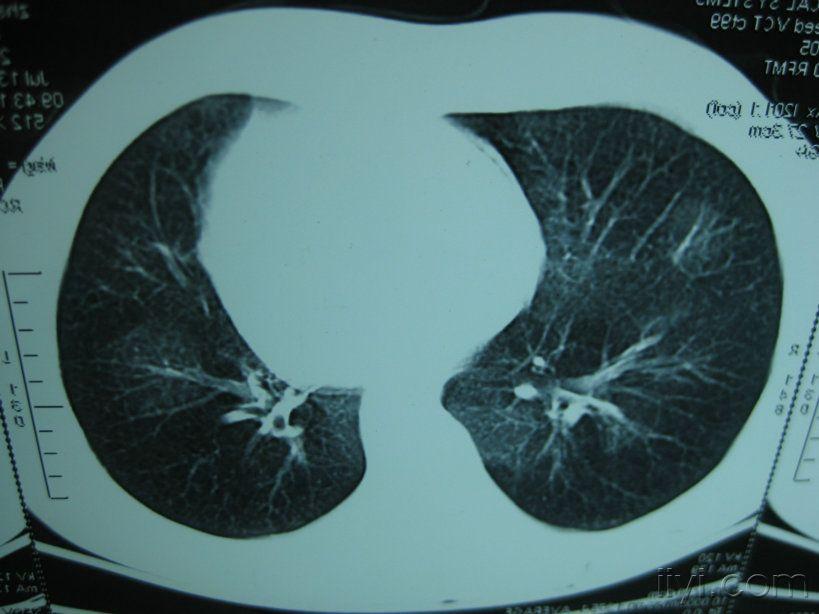 肺部毛玻璃样改变