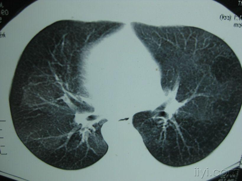 肺部毛玻璃片图片