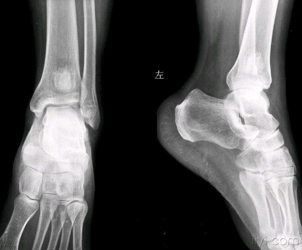 胫端下端骨质异常大家讨论骨梗死