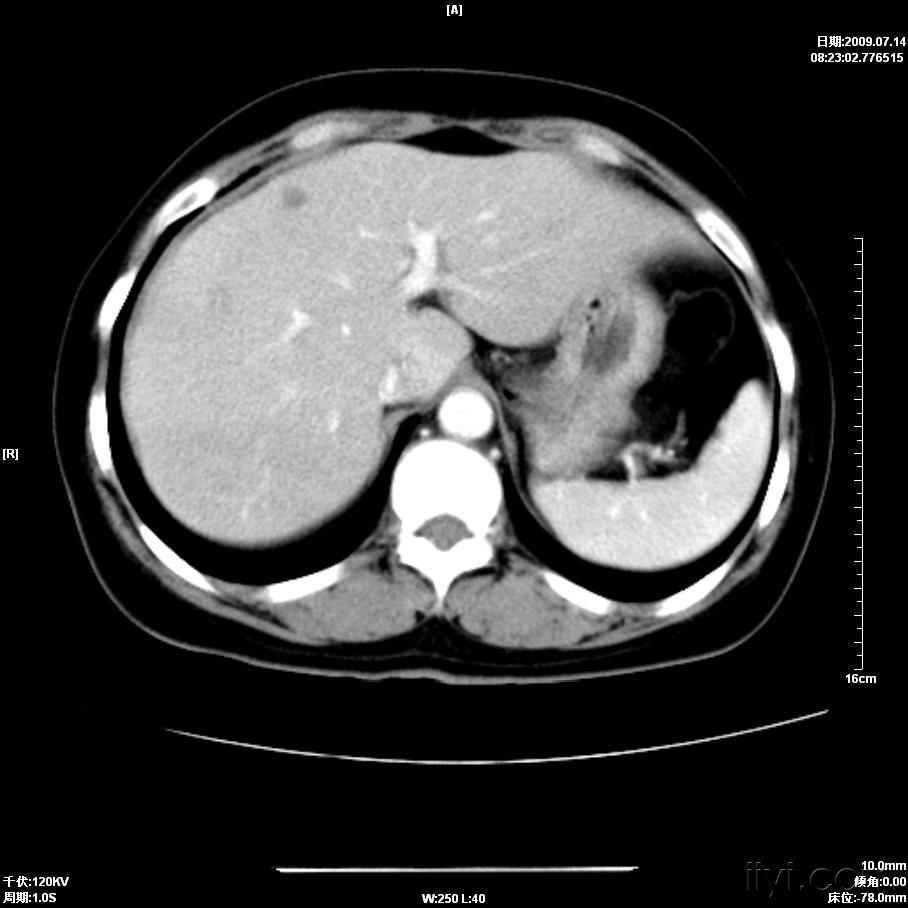 肝脏正常ct图片