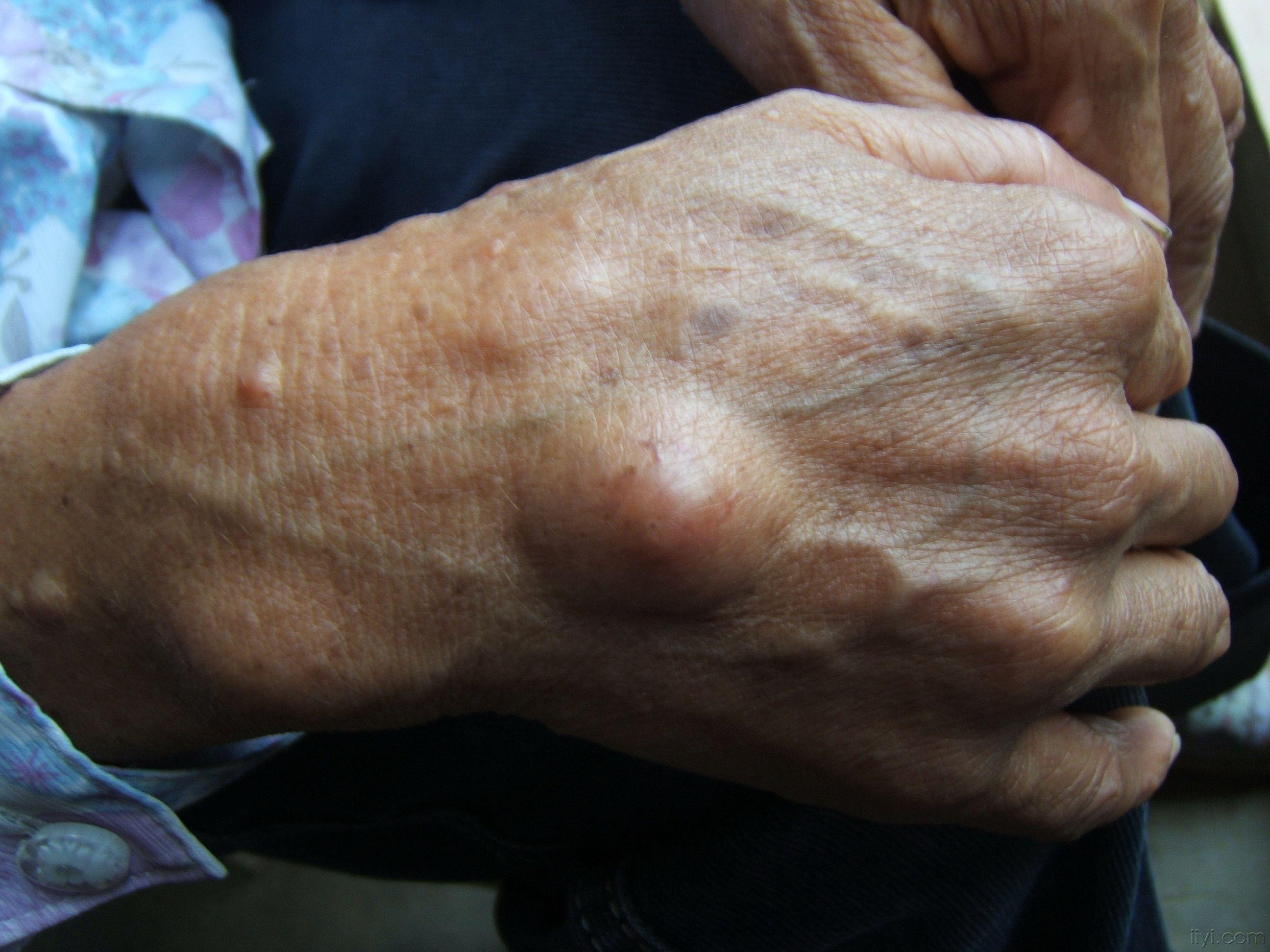 再来一个高清的典型的皮肤病图片告诉你诊断