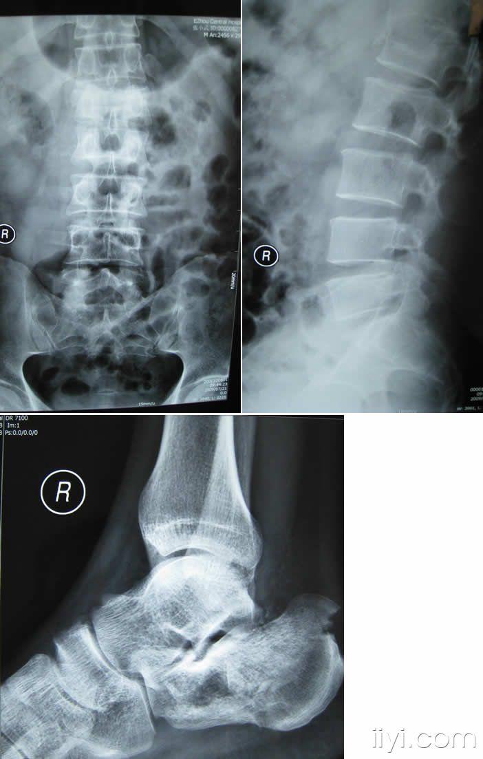 腰椎和跟骨骨折的討論