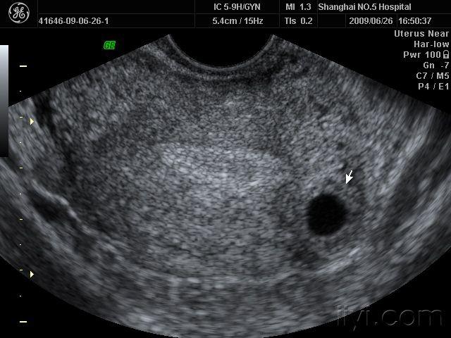 左宫角妊娠图片