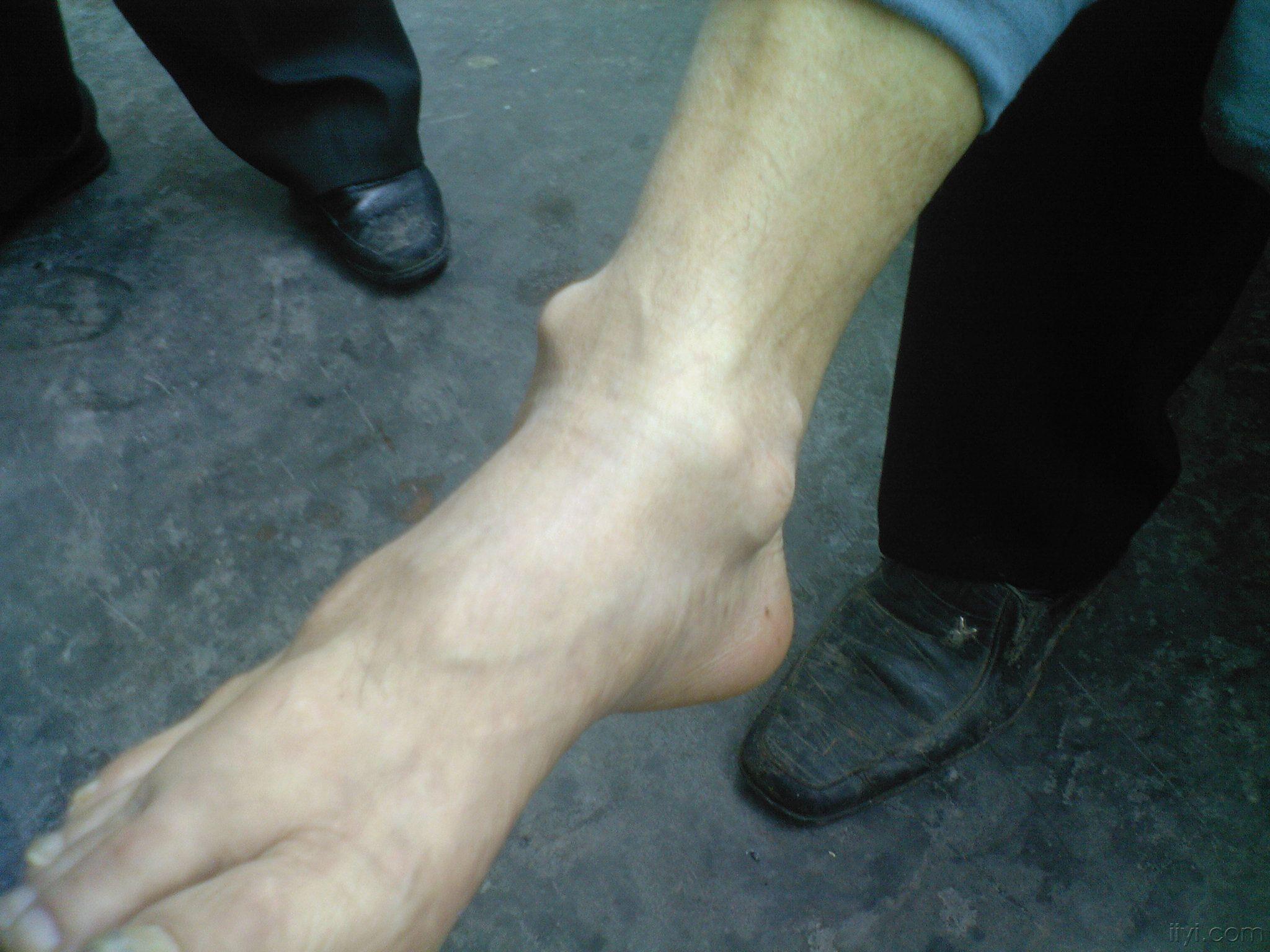 类风湿性关节畸形