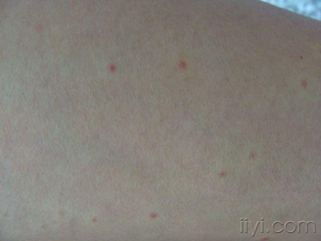 下肢红色丘疹