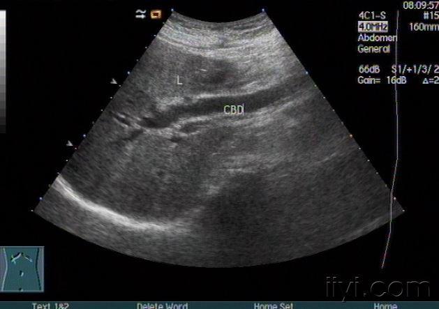 典型胆总管结石 - 超声医学讨论版 - 爱爱医医学论坛