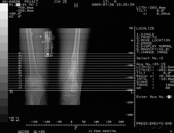 m17岁大腿痛1月该患者ct片已发请大家继速讨论