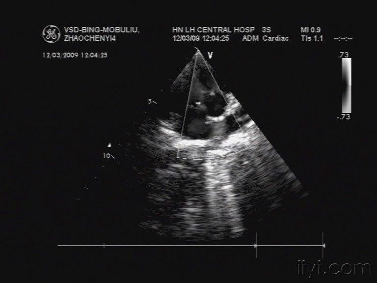 室间隔缺损并膜部瘤形成