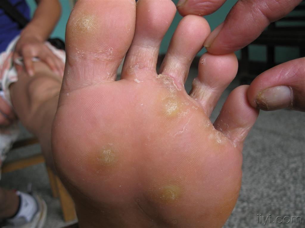 点灼加涂药治疗跖疣