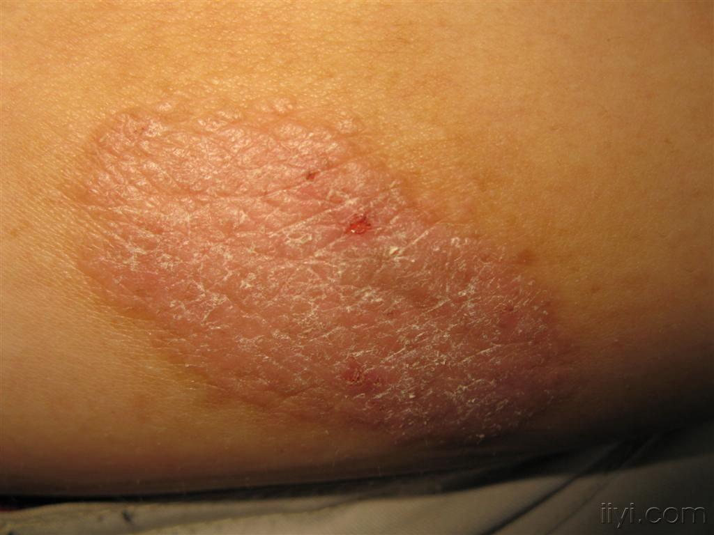 看图识病泛发性神经性皮炎