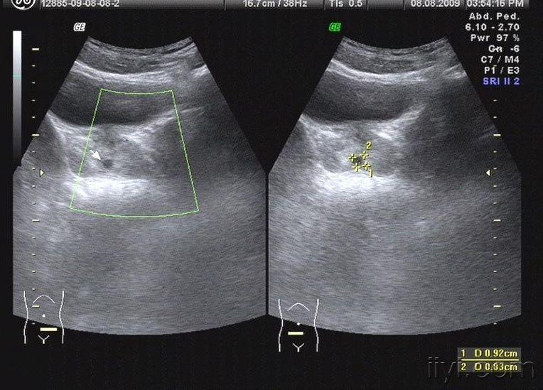 前列腺囊肿?**管囊肿? - 超声医学讨论版 - 爱爱医医学论坛