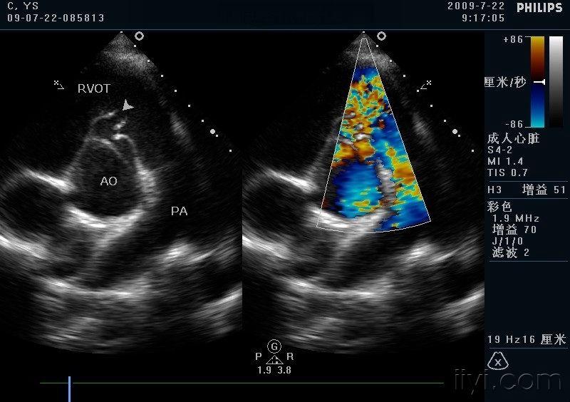 室间隔缺损 主动脉右冠窦瘤破入右室流出道