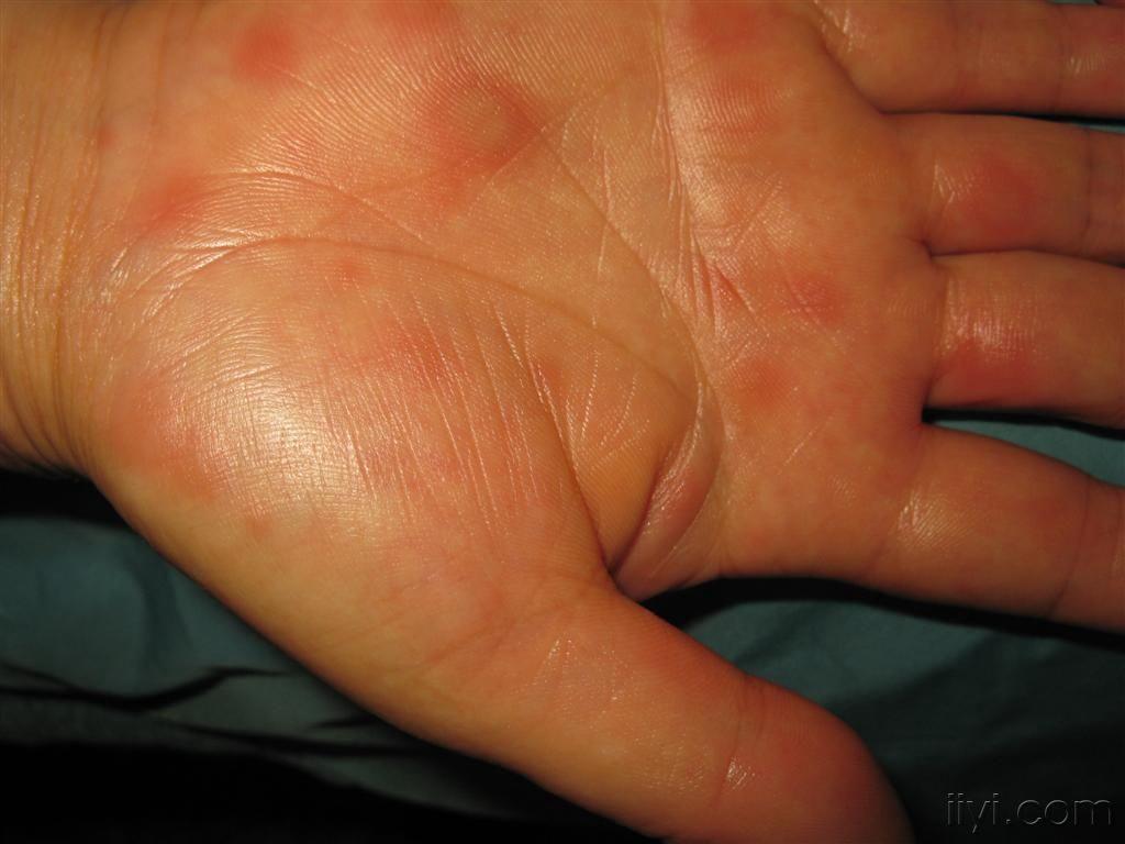 看图识病多形红斑