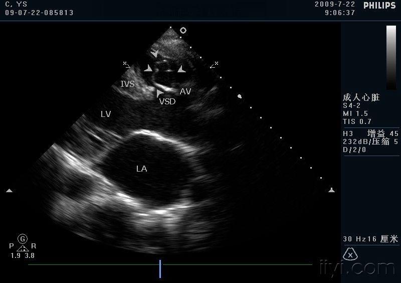 室间隔缺损 主动脉右冠窦瘤破入右室流出道 - 超声医学讨论版 - 爱爱