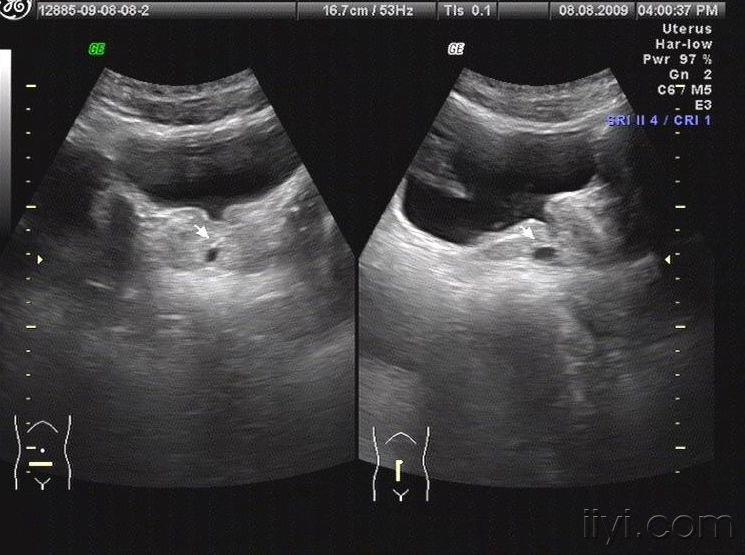 前列腺囊肿管囊肿