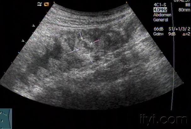 自认为---回盲瓣回声---zengerya - 超声医学讨论版 - 爱爱医医学论坛