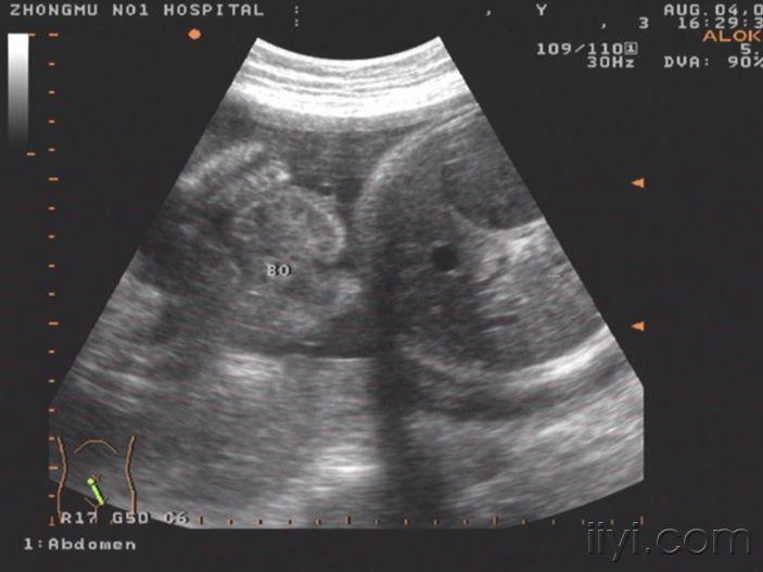 你见过这么大的胎儿胃泡吗你考虑什么畸形