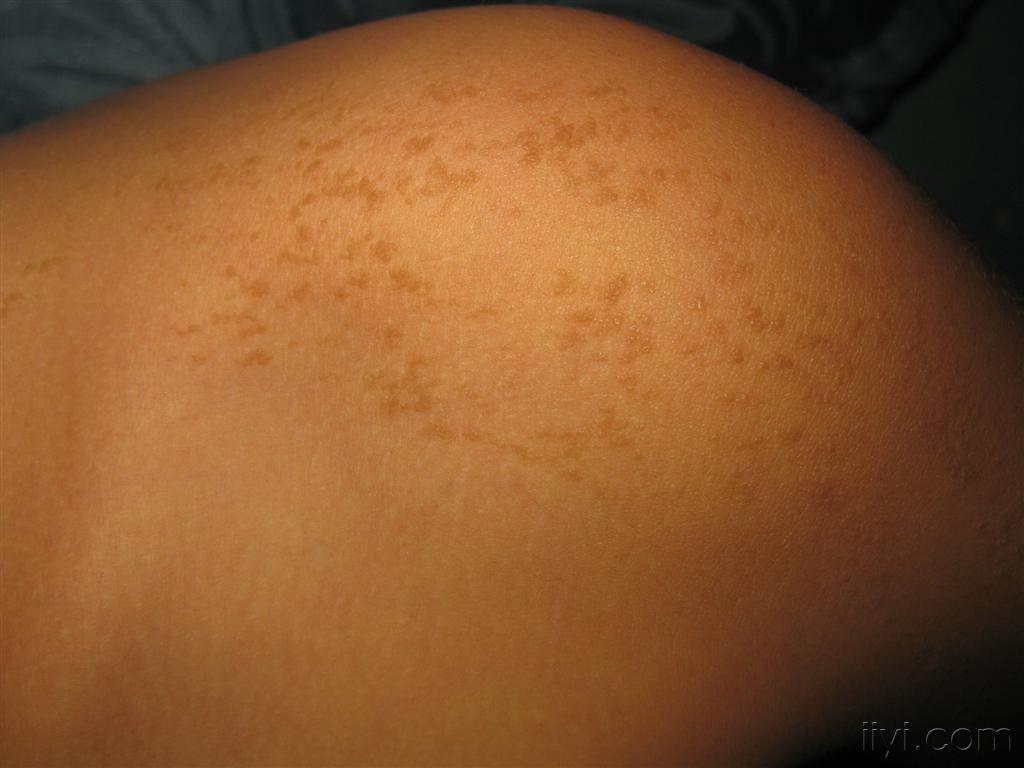 看图识病这些不痛不痒的小疹子是什么