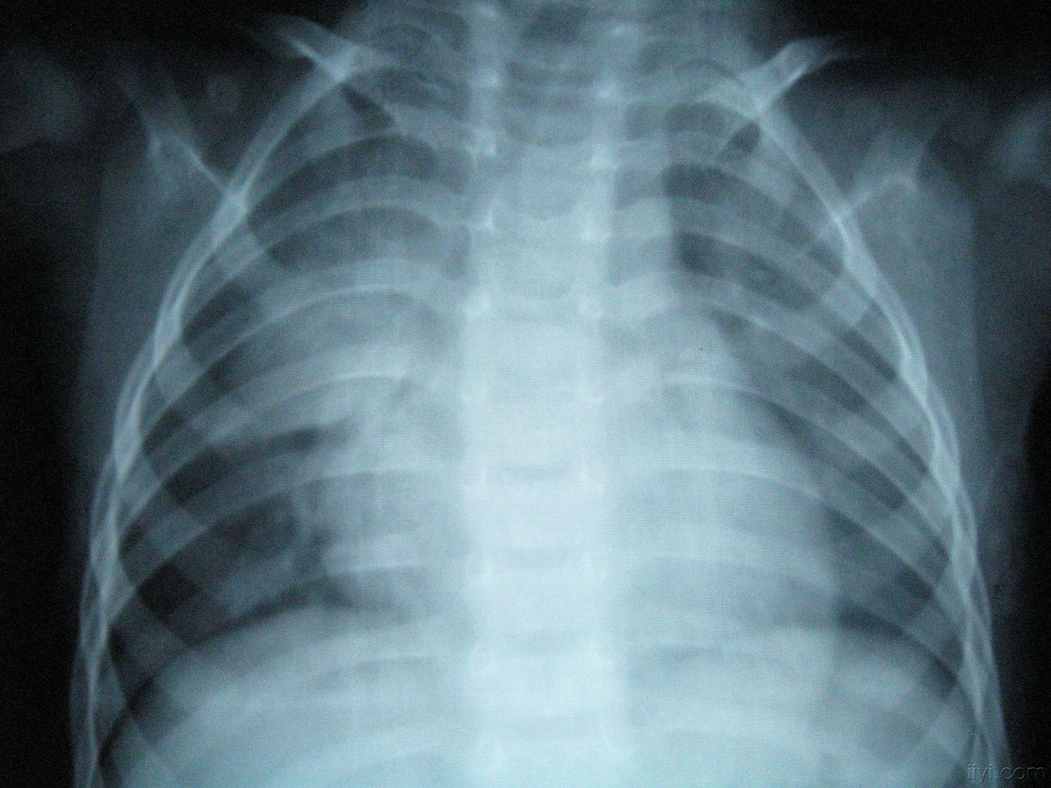 肺炎的x光片图片