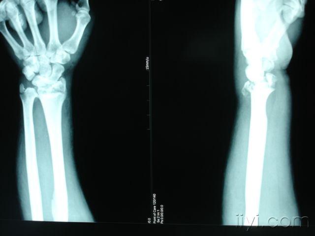 左尺骨茎突骨折图片